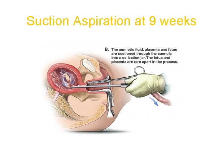 Suction Aspiration at 9 weeks 