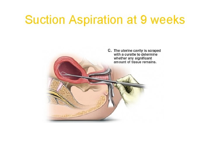 Suction Aspiration at 9 weeks 