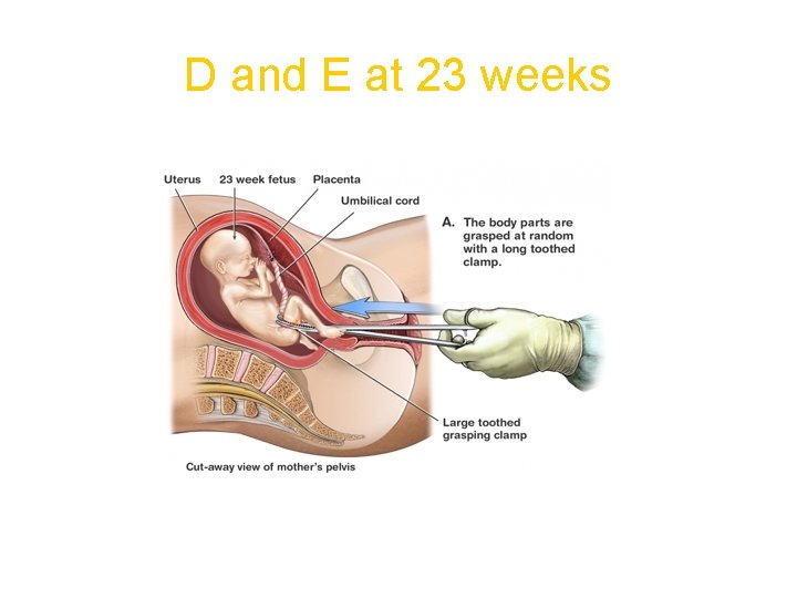 D and E at 23 weeks 
