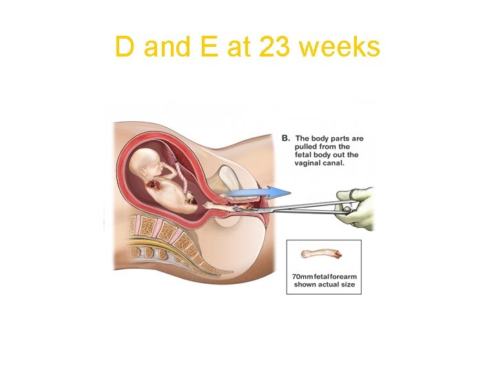 D and E at 23 weeks 