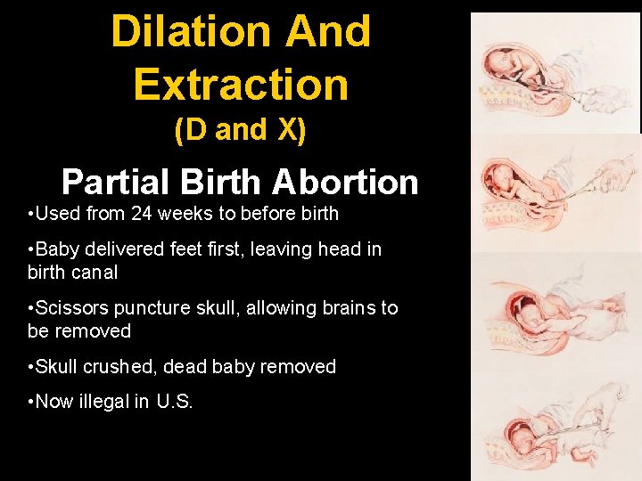 Dilation And Extraction (D and X) Partial Birth Abortion • Used from 24 weeks