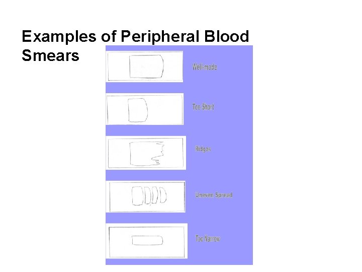 Examples of Peripheral Blood Smears 