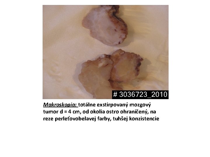 Makroskopia: totálne exstirpovaný mozgový tumor d = 4 cm, od okolia ostro ohraničený, na