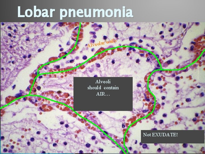 Lobar pneumonia ls wal r a l o e v Al Alveoli should contain