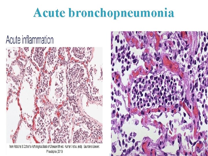 Acute bronchopneumonia 