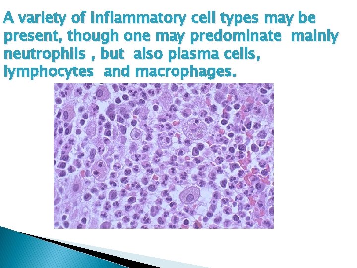 A variety of inflammatory cell types may be present, though one may predominate mainly