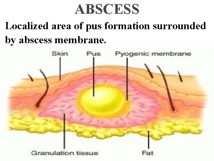 ABSCESS Localized area of pus formation surrounded by abscess membrane. 