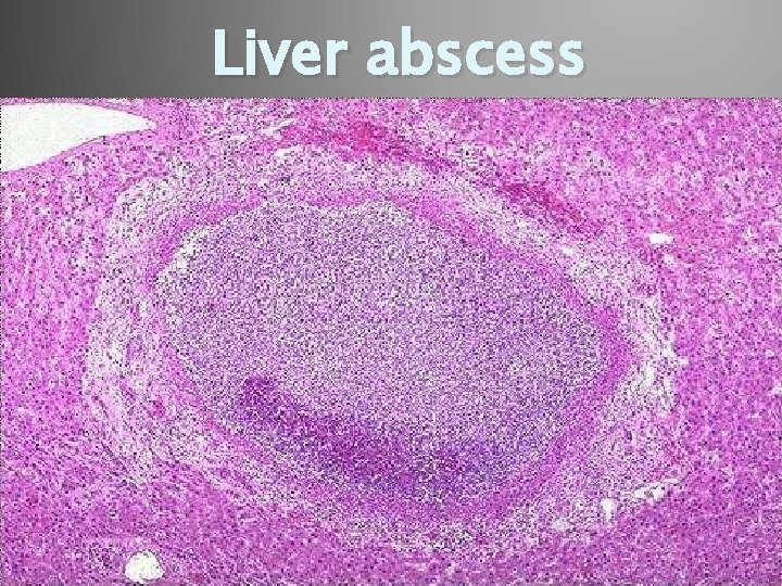 Liver abscess 