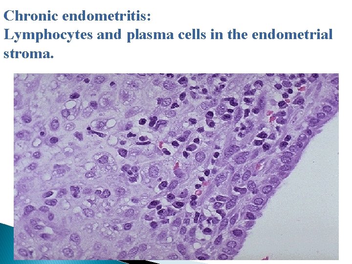 Chronic endometritis: Lymphocytes and plasma cells in the endometrial stroma. 