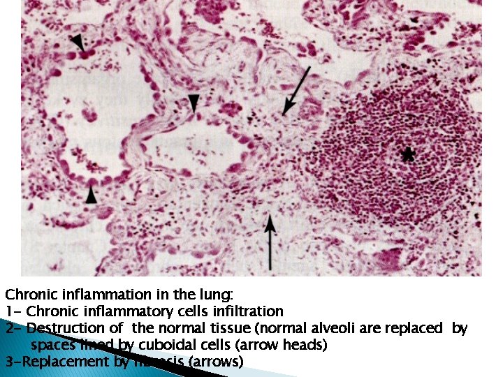 Chronic inflammation in the lung: 1 - Chronic inflammatory cells infiltration 2 - Destruction