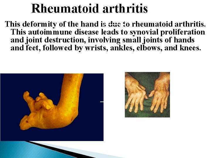Rheumatoid arthritis This deformity of the hand is due to rheumatoid arthritis. This autoimmune