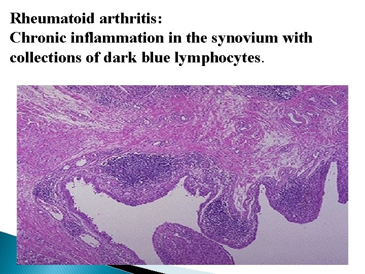 Rheumatoid arthritis: Chronic inflammation in the synovium with collections of dark blue lymphocytes. 