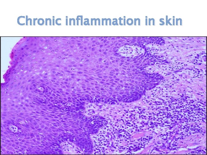 Chronic inflammation in skin 