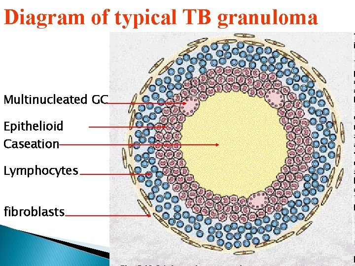 Diagram of typical TB granuloma Multinucleated GC Epithelioid cells Caseation Lymphocytes fibroblasts 