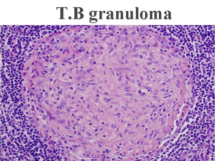 T. B granuloma 