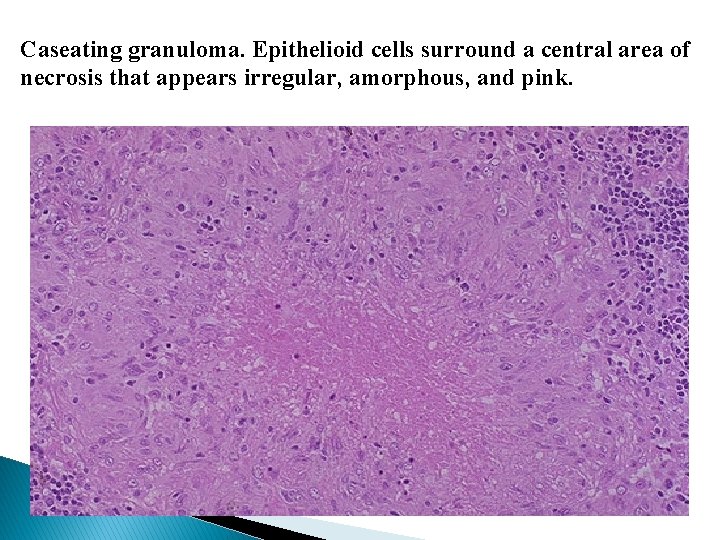 Caseating granuloma. Epithelioid cells surround a central area of necrosis that appears irregular, amorphous,