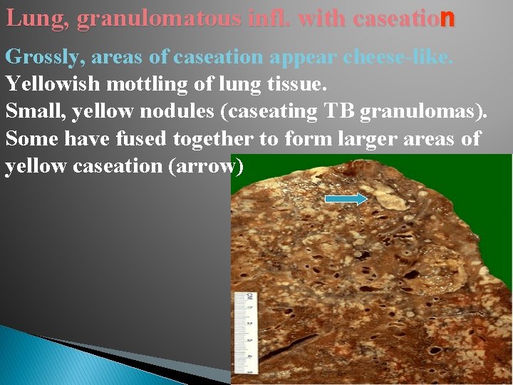 Lung, granulomatous infl. with caseation Grossly, areas of caseation appear cheese-like. Yellowish mottling of