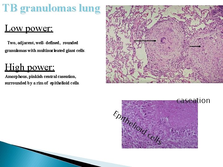 TB granulomas lung Low power: Two, adjacent, well- defined, rounded granulomas with multinucleated giant