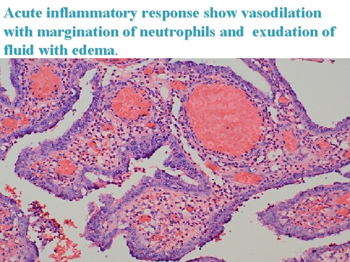 Acute inflammatory response show vasodilation with margination of neutrophils and exudation of fluid with