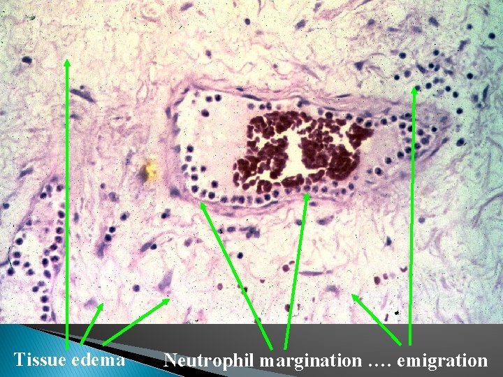 Tissue oedema Tissue edema Neutrophil margination …. And emigration Neutrophil margination …. emigration 