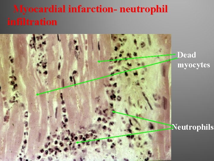 Myocardial infarction- neutrophil infiltration Dead myocytes Neutrophils 