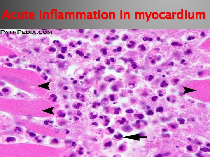 Acute inflammation in myocardium 