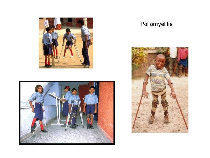 Poliomyelitis 