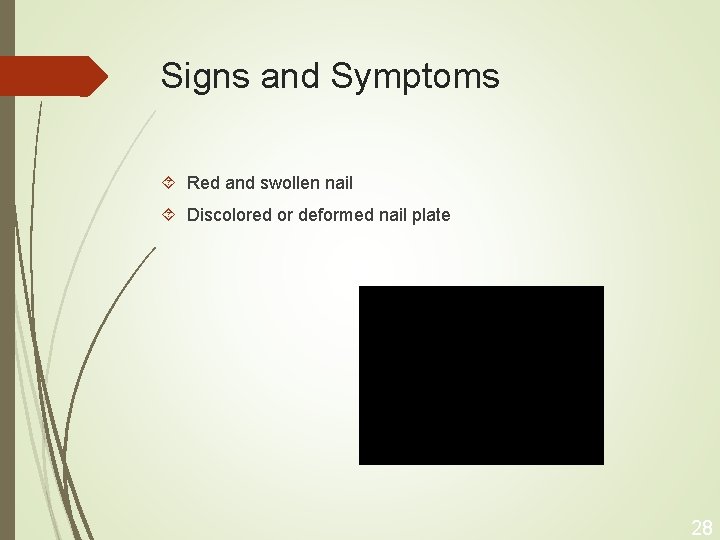 Signs and Symptoms Red and swollen nail Discolored or deformed nail plate 28 