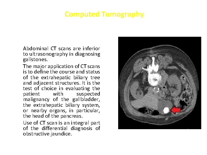 Computed Tomography Abdominal CT scans are inferior to ultrasonography in diagnosing gallstones. The major