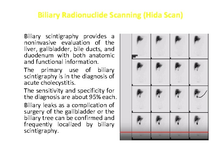 Biliary Radionuclide Scanning (Hida Scan) Biliary scintigraphy provides a noninvasive evaluation of the liver,