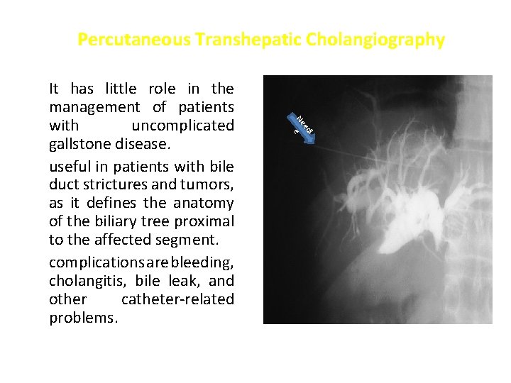 Percutaneous Transhepatic Cholangiography l ed Ne e It has little role in the management