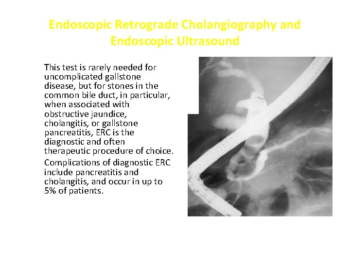 Endoscopic Retrograde Cholangiography and Endoscopic Ultrasound This test is rarely needed for uncomplicated gallstone