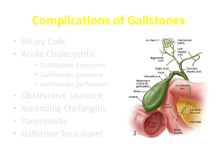 Complications of Gallstones • Biliary Colic • Acute Cholecystitis • Gallbladder Empyema • Gallbladder