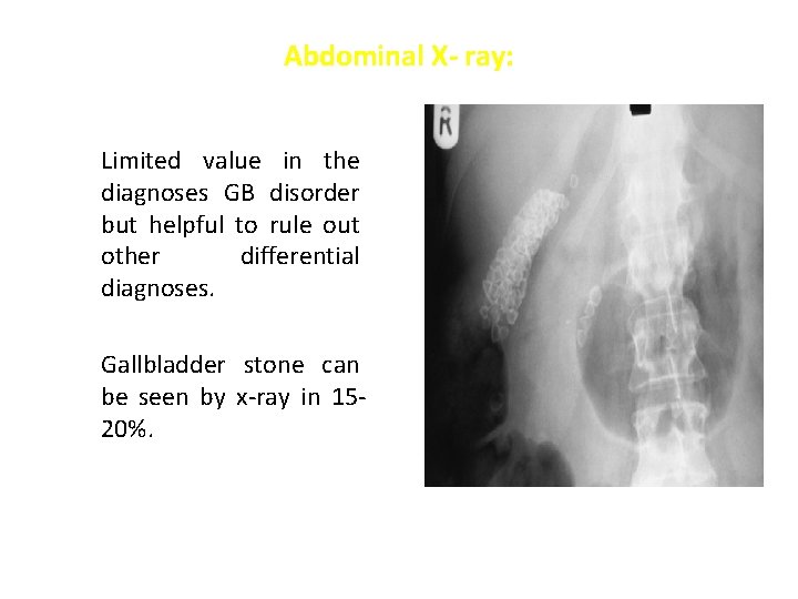 Abdominal X- ray: Limited value in the diagnoses GB disorder but helpful to rule