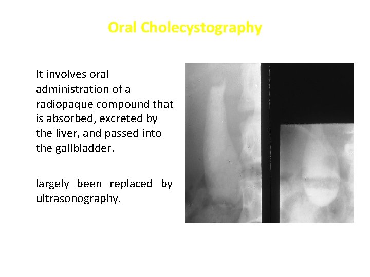 Oral Cholecystography It involves oral administration of a radiopaque compound that is absorbed, excreted