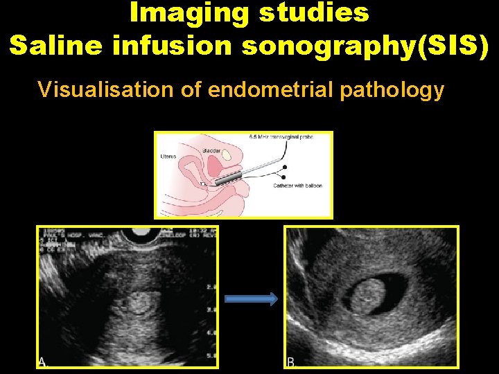 Imaging studies Saline infusion sonography(SIS) Visualisation of endometrial pathology 