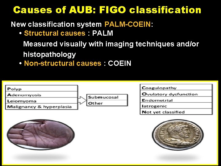 Causes of AUB: FIGO classification New classification system PALM-COEIN: • Structural causes : PALM