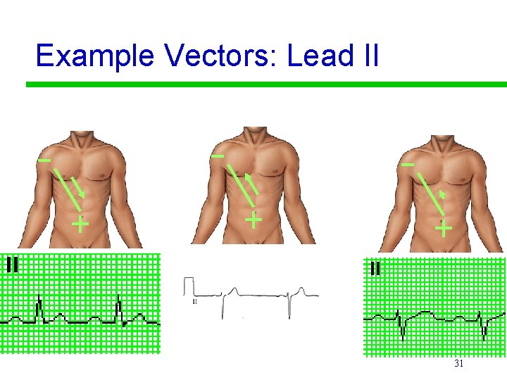 Example Vectors: Lead II 31 