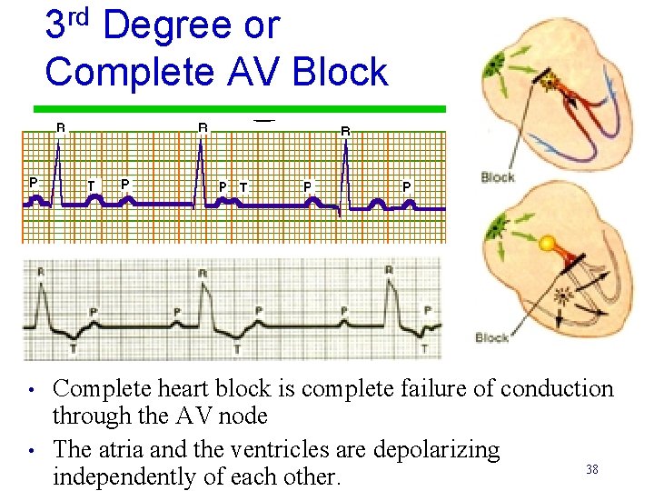 3 rd Degree or Complete AV Block • • Complete heart block is complete
