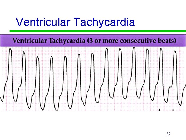 Ventricular Tachycardia 39 