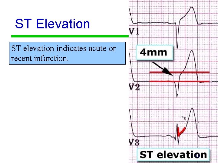 ST Elevation ST elevation indicates acute or recent infarction. 42 
