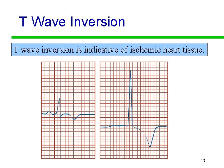 T Wave Inversion T wave inversion is indicative of ischemic heart tissue. 43 