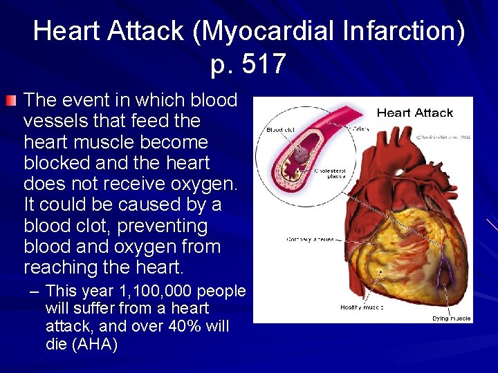 Heart Attack (Myocardial Infarction) p. 517 The event in which blood vessels that feed