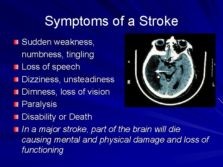 Symptoms of a Stroke Sudden weakness, numbness, tingling Loss of speech Dizziness, unsteadiness Dimness,