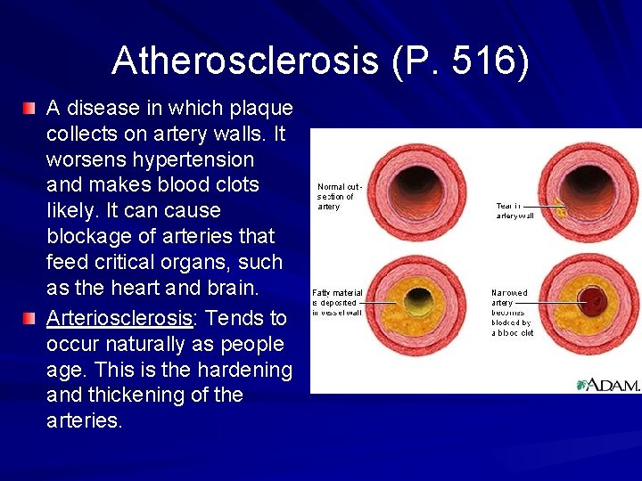 Atherosclerosis (P. 516) A disease in which plaque collects on artery walls. It worsens