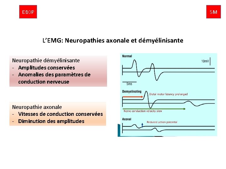 D 10 P SM L’EMG: Neuropathies axonale et démyélinisante Neuropathie démyélinisante - Amplitudes conservées