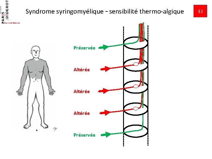 Syndrome syringomyélique – sensibilité thermo-algique Préservée Altérée Préservée EJ 