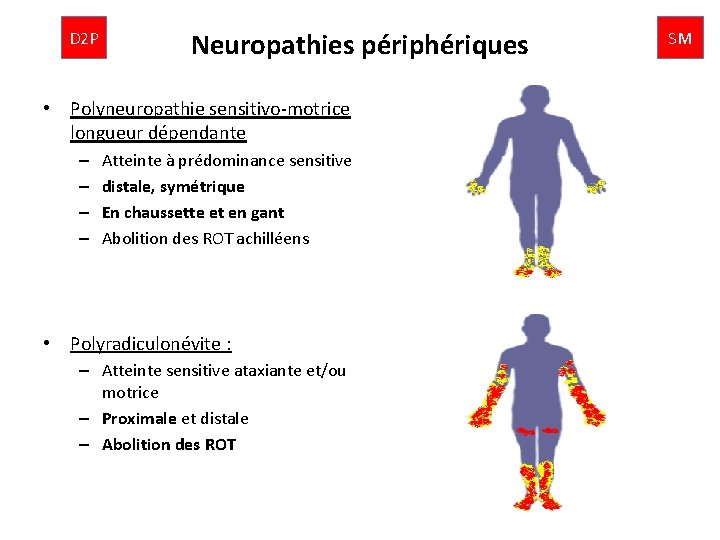 D 2 P Neuropathies périphériques • Polyneuropathie sensitivo-motrice longueur dépendante – – Atteinte à