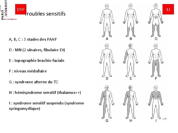 D 5 P Troubles sensitifs A, B, C : 3 stades PAAP D :