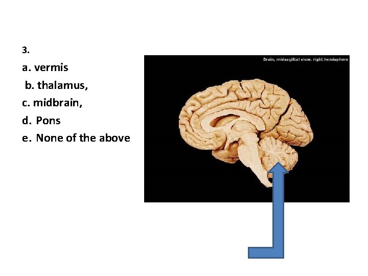 3. a. vermis b. thalamus, c. midbrain, d. Pons e. None of the above